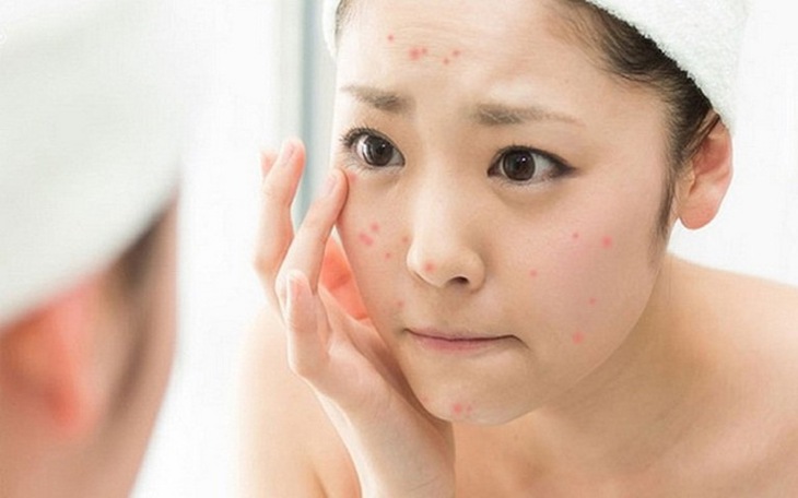Cần phân biệt nguyên nhân gây mụn để chăm sóc da hiệu quả.